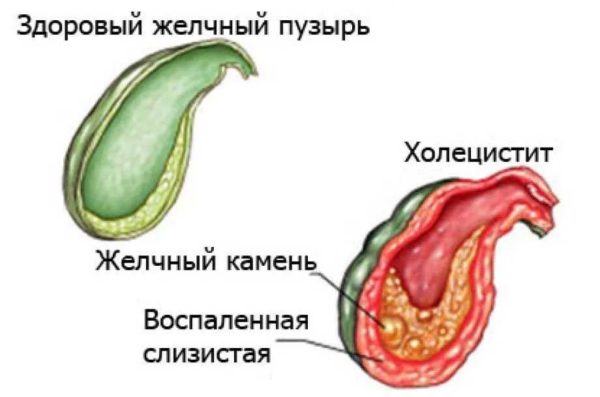 Воспаление желчного пузыря