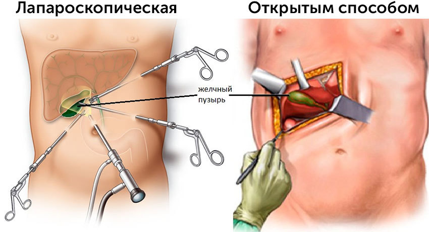 операция при раке желчного пузыря