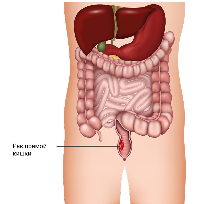 Рак прямой кишки: описание