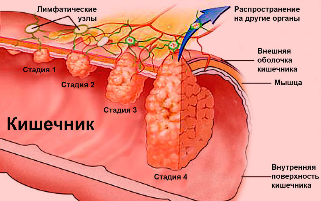 Стадии рака прямой кишки