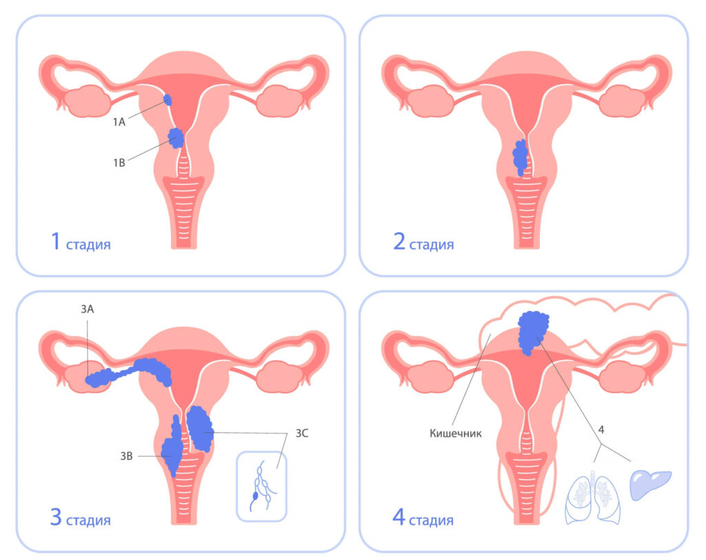 Рак матки стадии