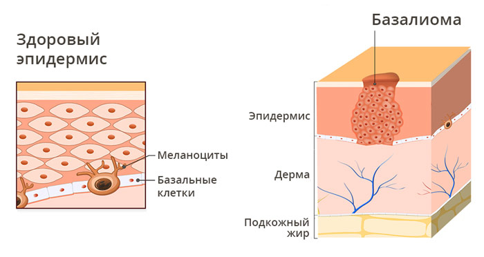 Базалиома, базальноклеточный рак. 