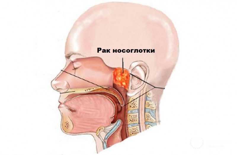 ✋Рак носоглотки: симптомы, методы диагностики  и лечение.